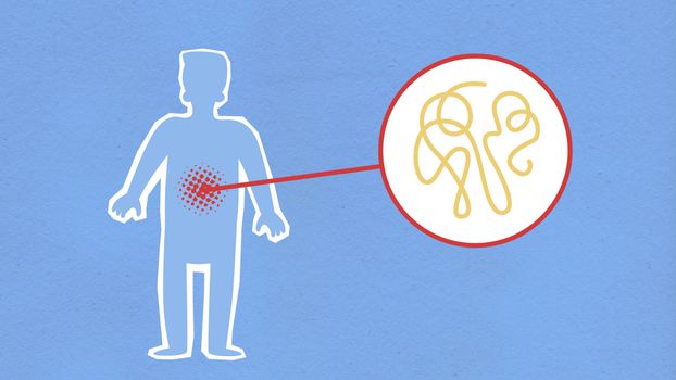 Infografía sobre síntomas de fibrosis quística en niños